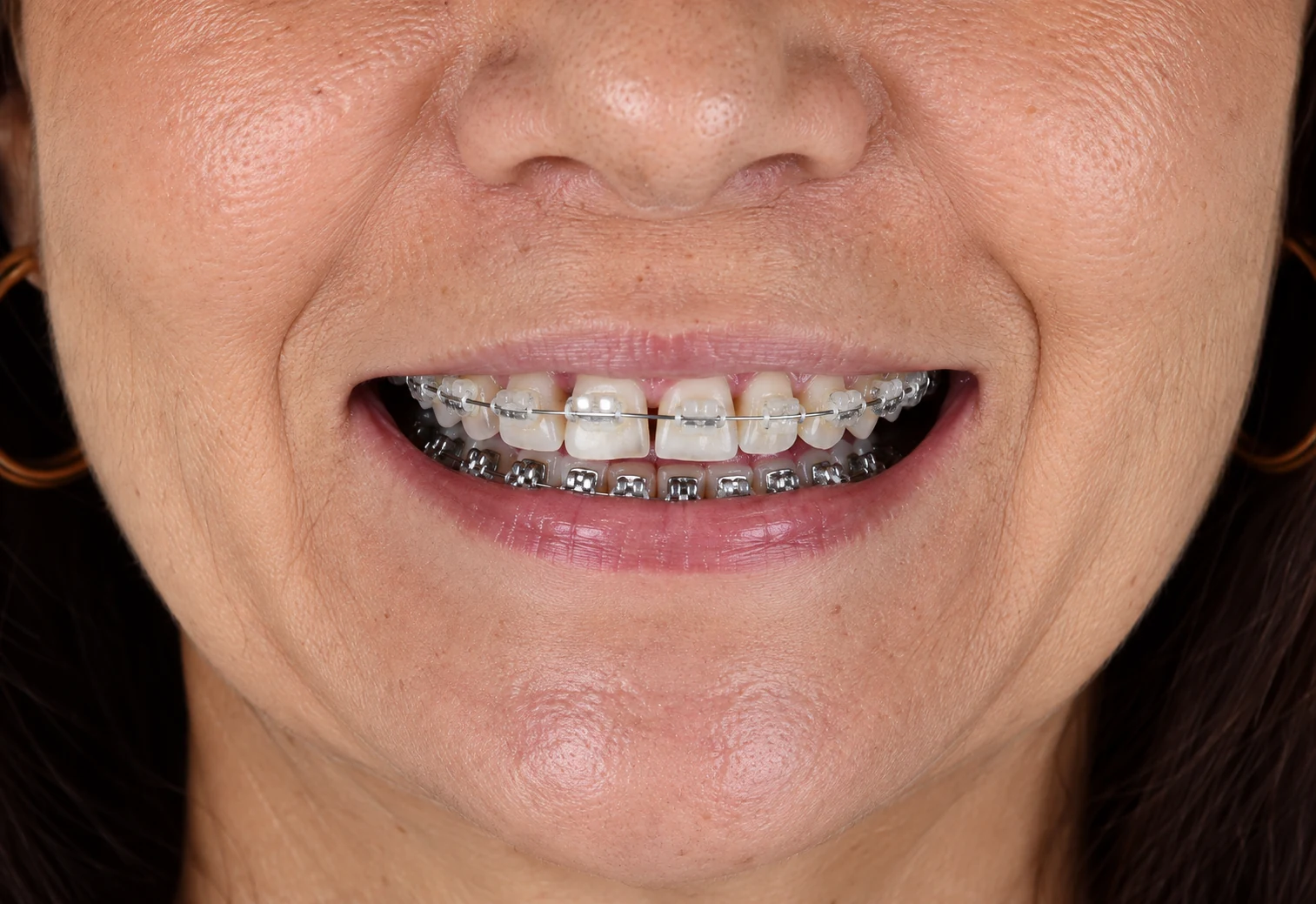 Antes — Estética do sorriso