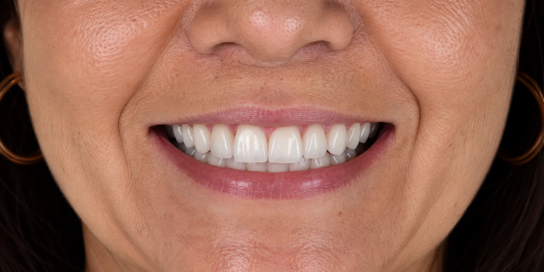 Depois — Estética do sorriso