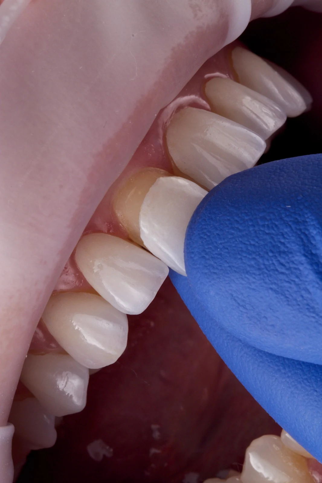 Faceta de porcelana para harmonização do sorriso