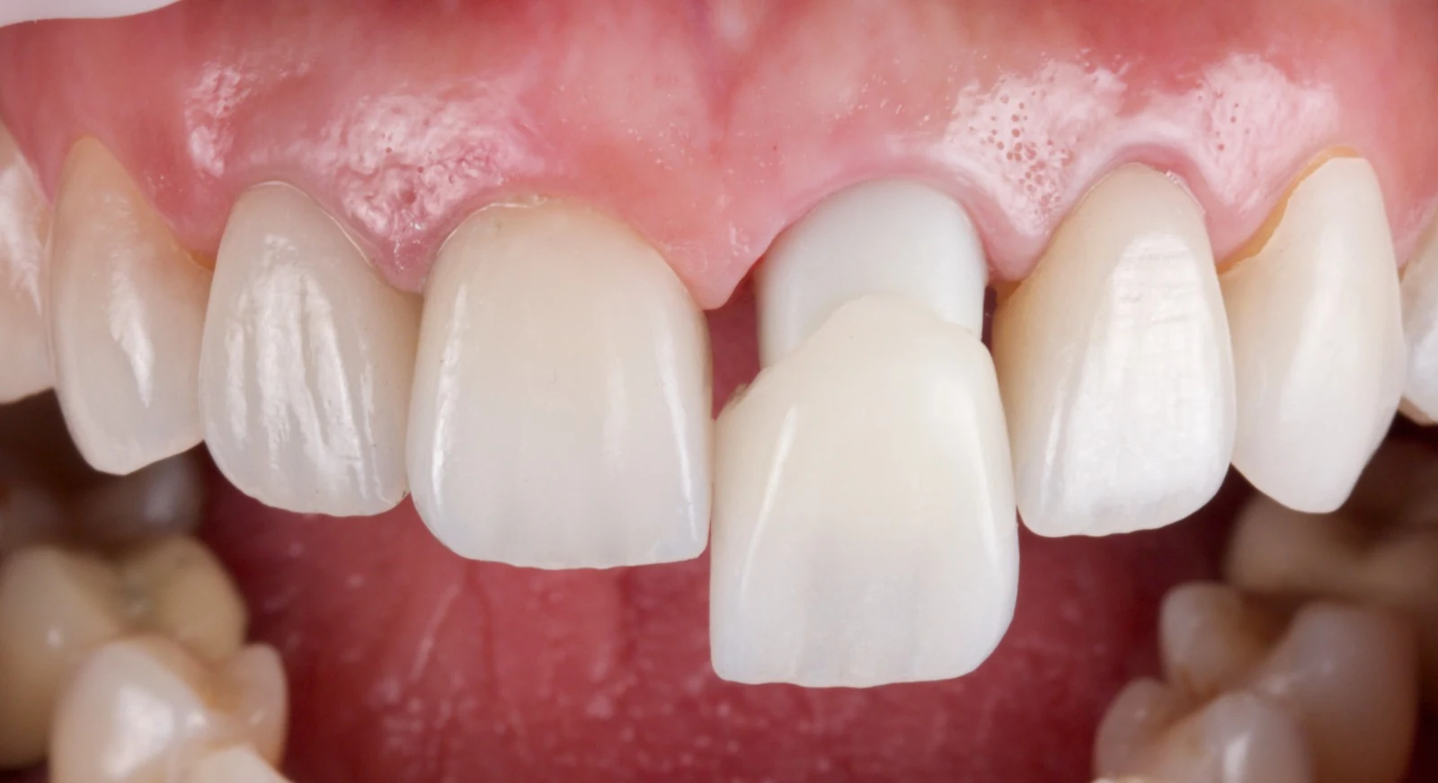 Prótese dentária personalizada para reabilitação do sorriso